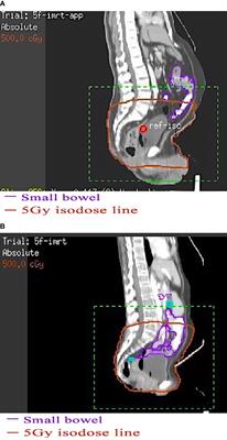 Effect of Abdominal Circumference on the Irradiated Bowel Volume in Pelvic Radiotherapy for Rectal Cancer Patients: Implications for the Radiotherapy-Related Intestinal Toxicity